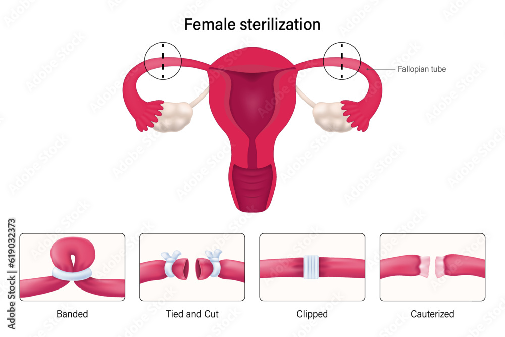 Female sterilization, Tubal ligation procedures vector. Banded, Tied