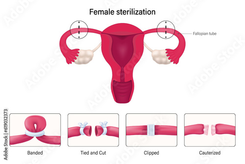 Female sterilization, Tubal ligation procedures vector. Banded, Tied and cut, Clipped and Cauterized. 