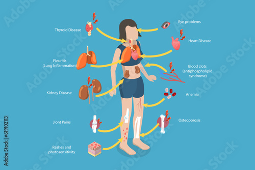 3D Isometric Flat Vector Conceptual Illustration of Lupus Erythematosus, SLE Symptoms and Signs