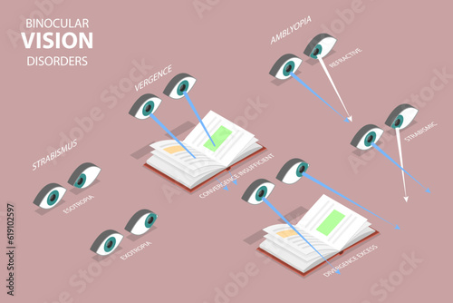 3D Isometric Flat Vector Conceptual Illustration of Binocular Vision Disorders, Medical Sight Health Problems