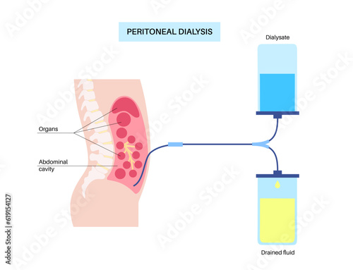 Peritoneal dialysis concept