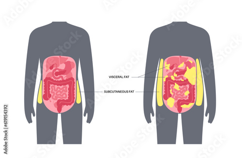 Visceral fat diagram