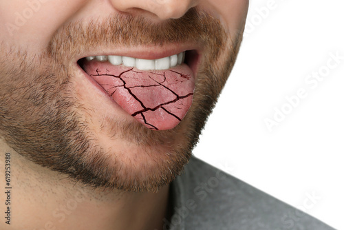 Dry mouth symptom. Man showing dehydrated tongue on white background, closeup