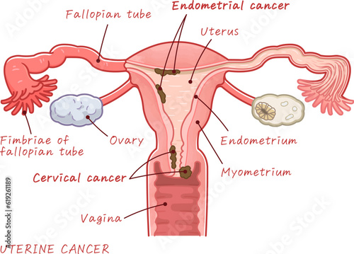 子宮体がん、子宮頸がん、Uterine cancer、Endometrial cancer、Cervical cancer、イラスト、illustration