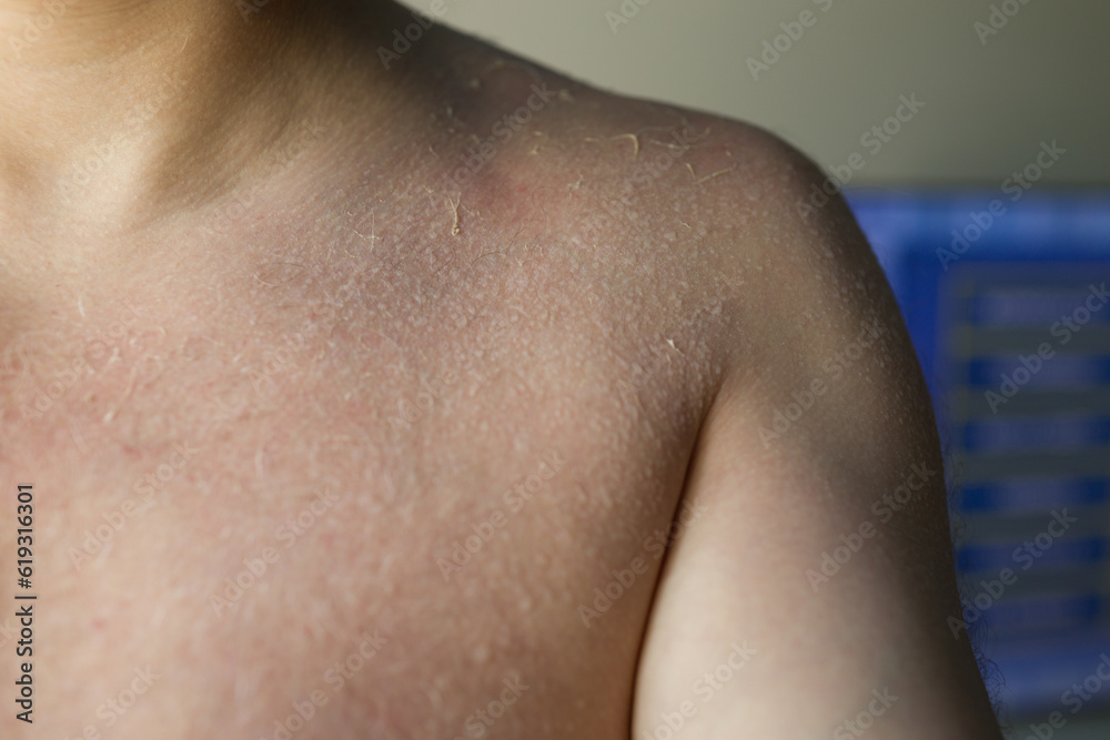 Fototapeta premium Man sunburn skin damage peeled off after exposure sun burn