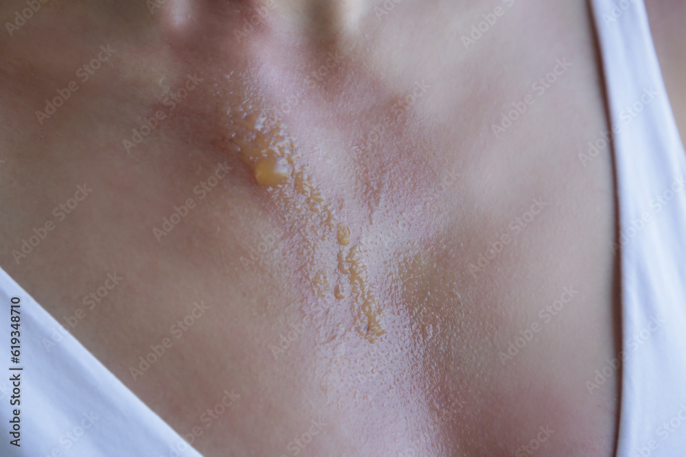 Fototapeta premium A second-degree burn with blister on woman's chest