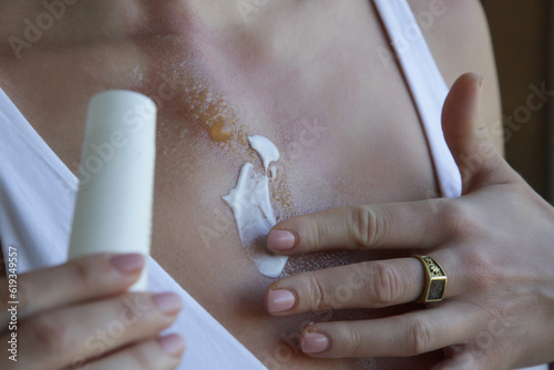 Woman applaying ointment on second-degree burn with blister on her chest