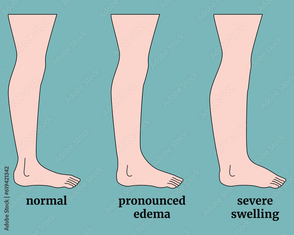 Stages of human leg edema. Medical background or poster. Vector flat