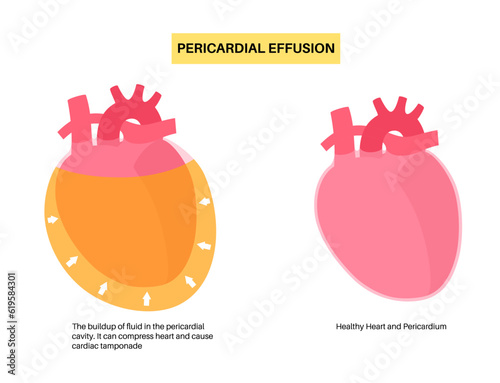 Pericardial effusion heart