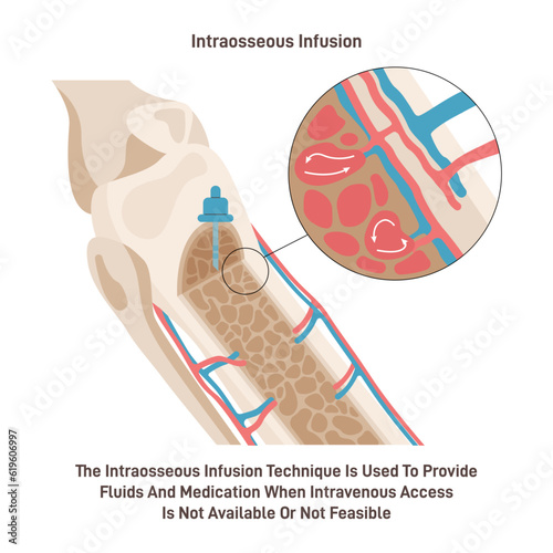 Intraosseous injection technique. Process of injecting medications