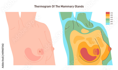 Thermography of female chest. Thermographic image of breast