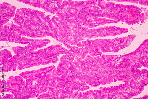 Backgrounds of human cells tissue of lung human under the microscope in pathology lab.View in microscopic of ductal cell carcinoma, adenonocarcinoma from human breast cancer, tissue section by H and E photo