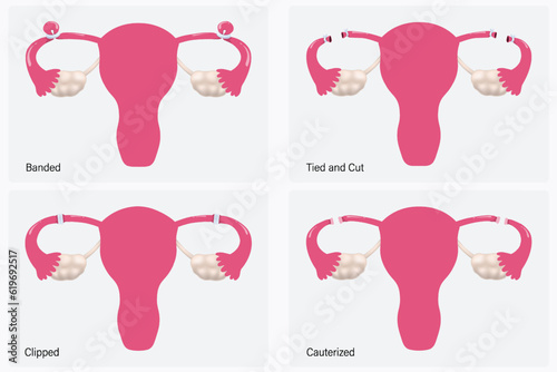 Female sterilization, Tubal ligation methods vector. Banded, Tied and cut, Clipped and Cauterized. 