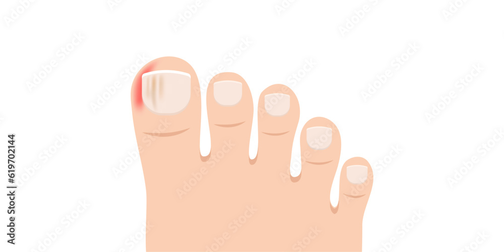 Swollen toe cartoon vector. Person feet with nail disease or infection. Foot with onychomycosis or fungus on fingers