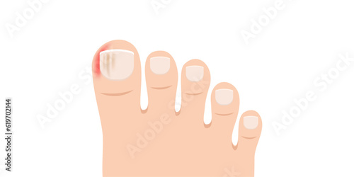 Obraz na płótnie Swollen toe cartoon vector. Person feet with nail disease or infection. Foot with onychomycosis or fungus on fingers w salonie