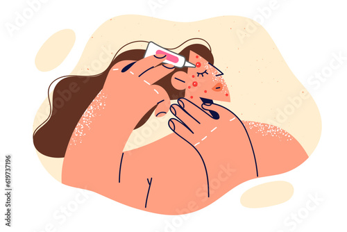 Woman applies cream to pimple on face, fights rash and redness associated with puberty