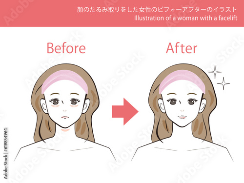 顔のたるみ取り（フェイスリフト）をした女性のビフォーアフターのイラスト　-　肌は白色で塗られています。
