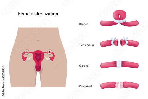 Type of tubal ligation procedures vector. Female sterilization. Banded, Tied and cut, Clipped and Cauterized. 
