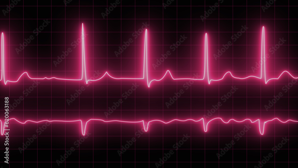 Electrocardiogram with cardiac arrhythmia. Neon atrial fibrillation has been recorded as the source of many cerebrovascular accidents or strokes.