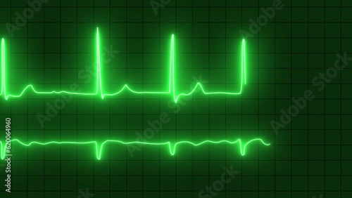 ECG with supraventricular premature beats and short paroxysms of neon atrial fibrillation animation. photo