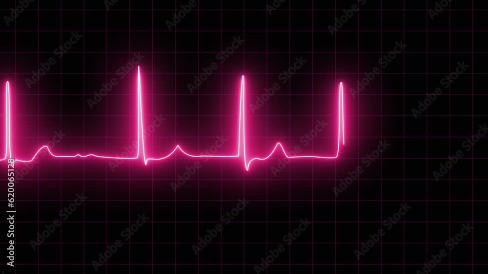 neon Atrial fibrillation ECG loop animation. ECG with supraventricular premature beats and short paroxysms of neon atrial fibrillation animation. Loop EKG Heart Rate In Normal Sinus Rhythm neon Atrial fibrillation ECG loop animation. ECG with supraventricular premature beats and short paroxysms of neon atrial fibrillation animation. Loop EKG Heart Rate In Normal Sinus Rhythm