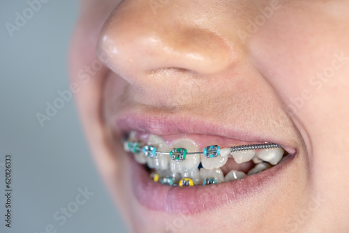 Teenage girl with braces on her teeth, close-up of a smile.