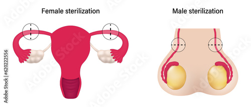Female sterilization and male sterilization vector. Tubal ligation procedures. 