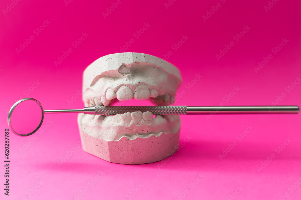 Dental casting gypsum model of human jaws. Crooked teeth and distal