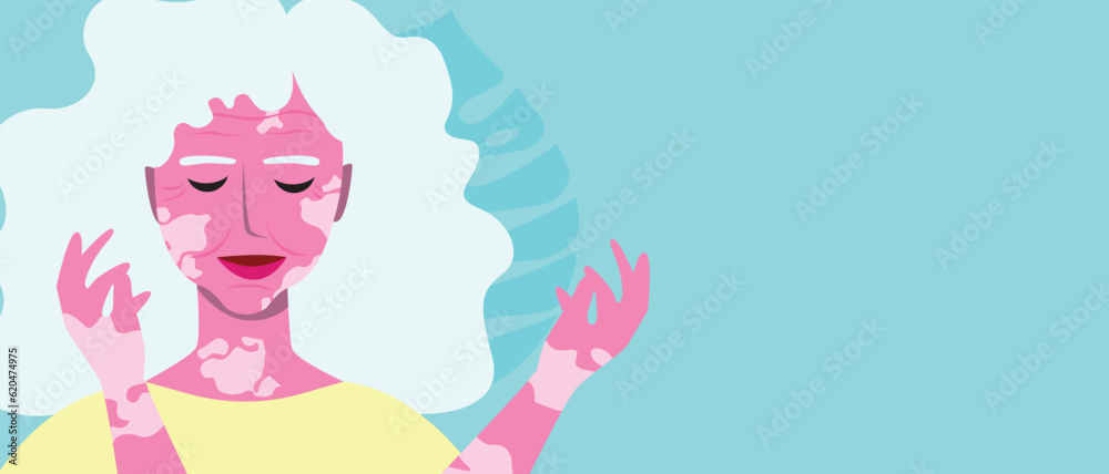 Elderly woman with vitiligo and tropic leaves, copy space template for design or flat vector stock illustration