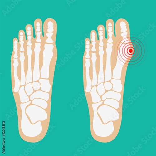 Valgus deformity of the big toe. Foot health care. Vector illustrations.