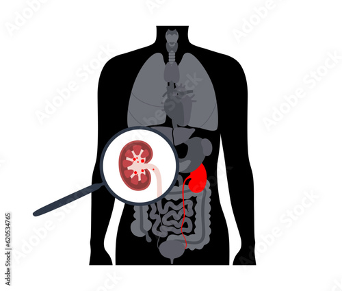 Kidney stones treatment
