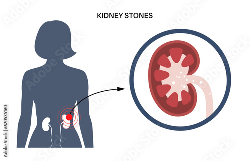 Kidney stones treatment