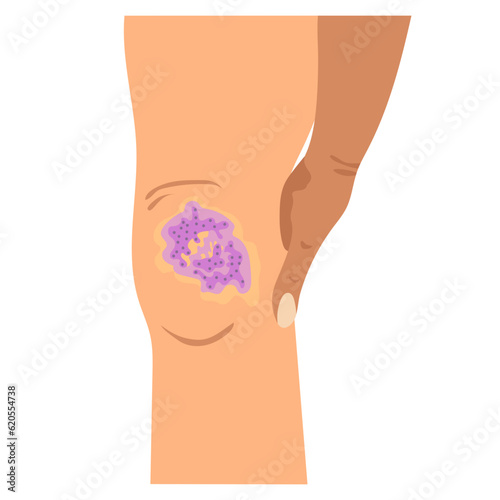 bruise