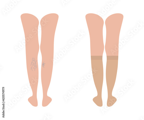 Varicose veins. Women's Knee-high short compression stockings. Female legs behind with Varicoses. Medical underwear for feet. Blood pressure. Specialized hosiery for diseases. Vector illustration.