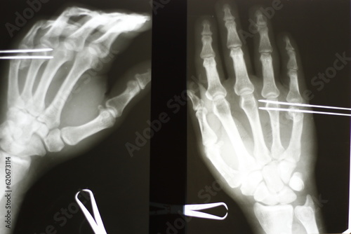 Surgical plates for osteosynthesis in case of bone fractures	 photo