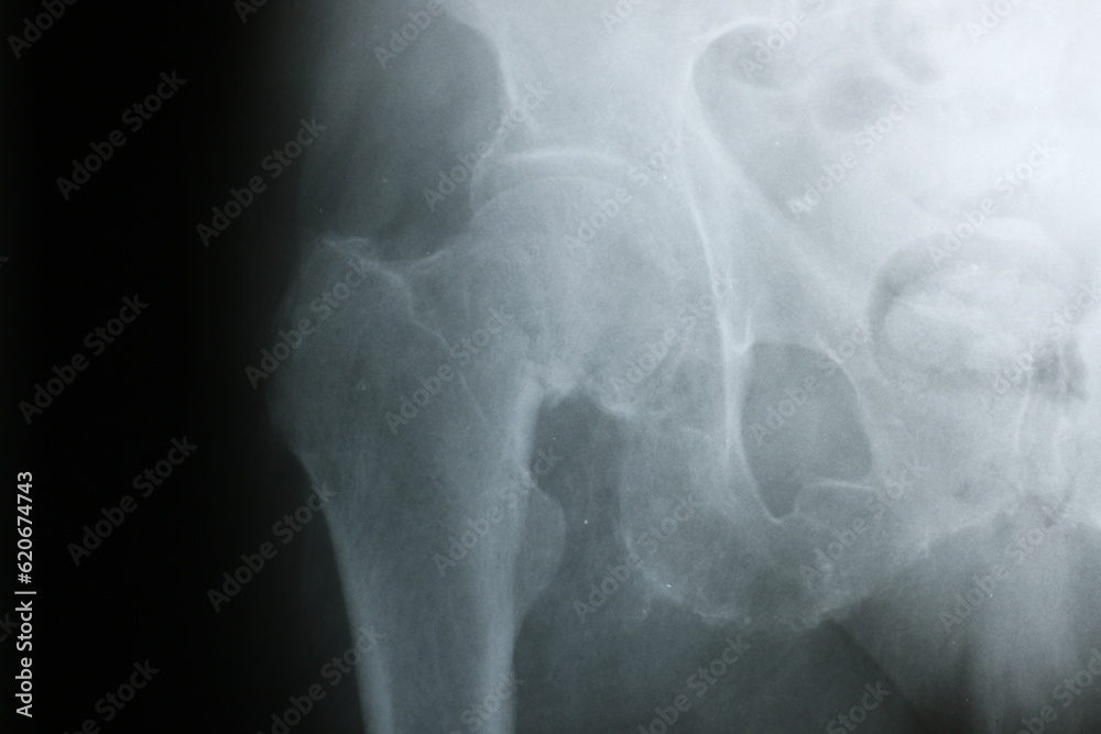 Surgical plates for osteosynthesis in case of bone fractures Surgical plates for osteosynthesis in case of bone fractures