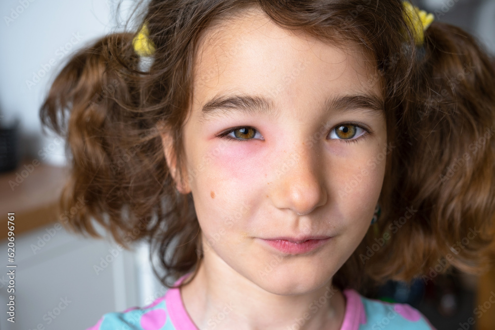 Foto de A red swollen eyelid on a child face in closeup is an allergy