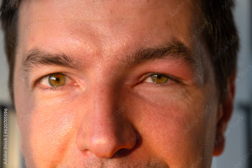 A red swollen eyelid on a man's face in close-up is an allergy to an insect bite. Allergic reaction to blood-sucking insects A red swollen eyelid on a man's face in close-up is an allergy to an insect bite. Allergic reaction to blood-sucking insects