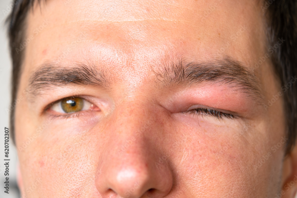A red swollen eyelid on a man's face in close-up is an allergy to an insect bite. Allergic reaction to blood-sucking insects
