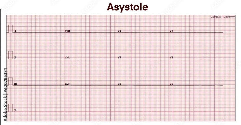Electrocardiogram show asystole Electrocardiogram show asystole
