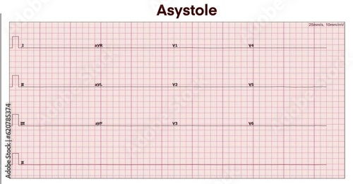 Electrocardiogram show asystole