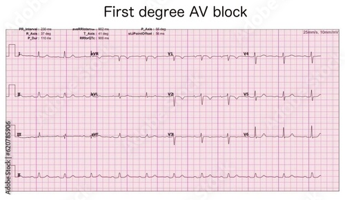 Electrocardiogram show First degree AV block