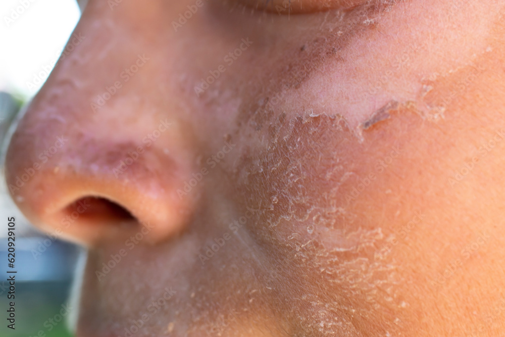 Sun burn on a child's face skin,  close up