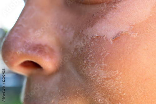 Sun burn on a child's face skin, close up