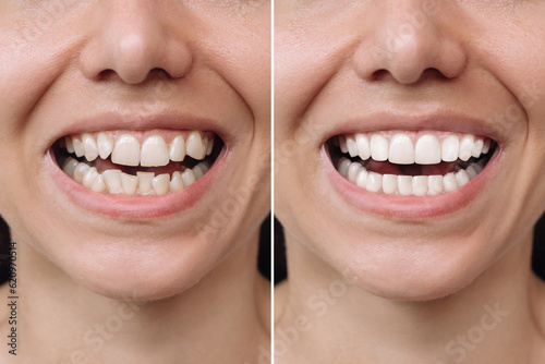 Fotografia Cropped shot of a young caucasian smiling woman before and after veneers installation