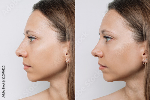 Profile of woman's face with nose before and after rhinoplasty isolated on gray background. The result of cosmetic plastic surgery on the nose. Correction of a nasal septum. Getting rid of the hump