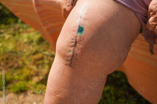 recovery and wound healing on the human body. scar from operation. postoperative suture on the male leg.
