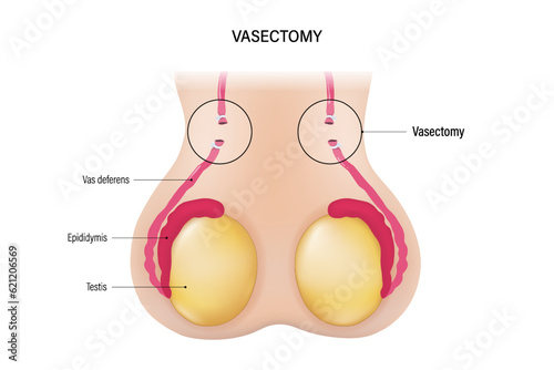 Vasectomy. Vasoligation. Male sterilization procedure vector. Permanent contraception.