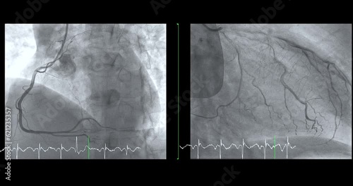 Cardiac catheterization showing coronary arteries  used to diagnose and treat some heart conditions such as myocardial infarction.