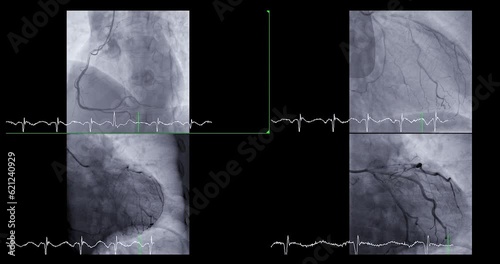 Cardiac catheterization showing coronary arteries  used to diagnose and treat some heart conditions such as myocardial infarction.